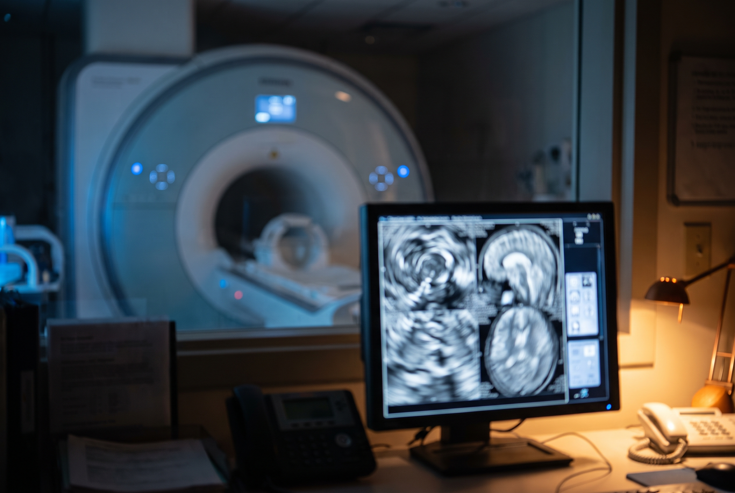 Alzheimer's may leave traces in the brain years earlier than we could see